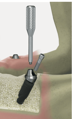 MUA angle abutment holder